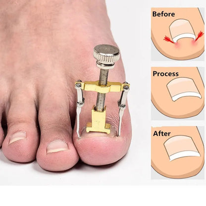 Tcare Ingrown Toenails Correction Pedicure Foot Toe Nail Care Tools Straightening Clip Brace Corrector Ingrown Toe Nail Fixer