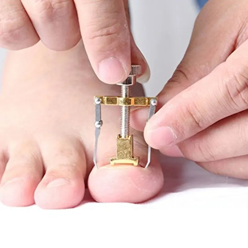 Tcare Ingrown Toenails Correction Pedicure Foot Toe Nail Care Tools Straightening Clip Brace Corrector Ingrown Toe Nail Fixer