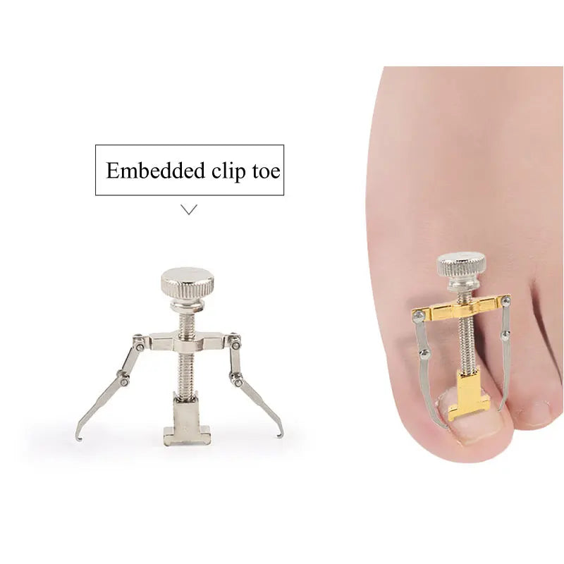 Tcare Ingrown Toenails Correction Pedicure Foot Toe Nail Care Tools Straightening Clip Brace Corrector Ingrown Toe Nail Fixer